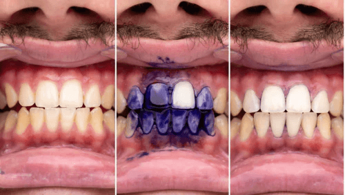 Pasta de dientes púrpura con tecnología corrector de color EHOHE