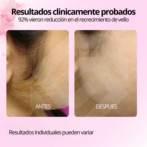 Aceite de Cyperus Rotundus para Reducción del Vello