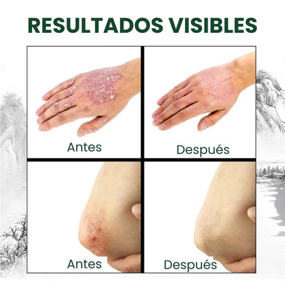 OFERTA 2X1, Crema Antifúngica y Antipicazón – Tratamiento Natural para Hongos y Psoriasis