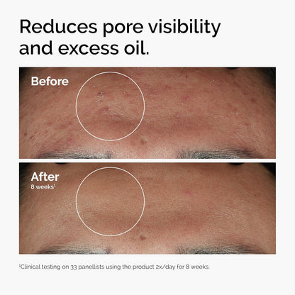 The Ordinary - Niacinamida 10% + Zinc 1%, Suero para pieles con tendencia a imperfecciones