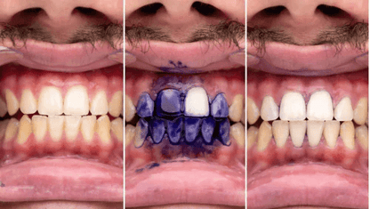 Pasta de dientes púrpura con tecnología corrector de color EHOHE